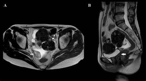 Torsion Of A Rudimentary Uterine Horn With Multiple Leiomyomas In A