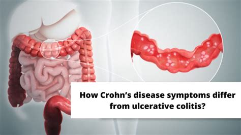 What Is Crohns Disease Causes And Symptoms And Risk Factors
