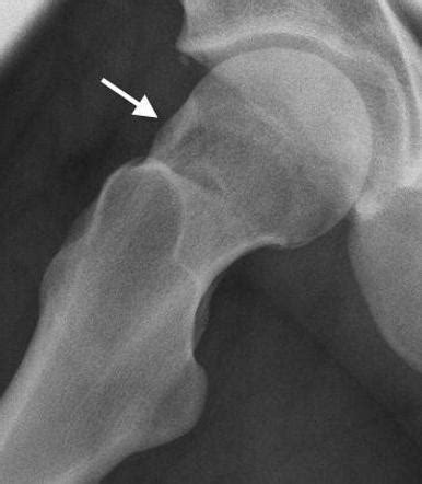 Hip Impingement Syndromes Overview Radiology Reference Article