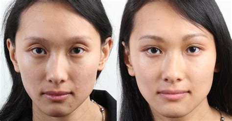 He tightens the forehead muscles, and removes excess skin and tissue. Non-surgical Eyebrow lift