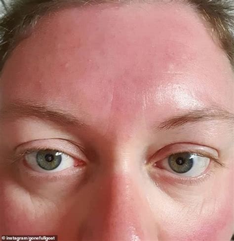 Baked Brits Share Snaps Of Their Disastrous Sunburn Following The