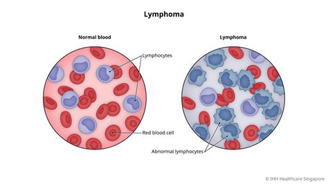 Lymphoma Symptoms And Causes Mount Elizabeth Hospitals