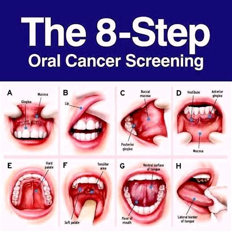 Oral Cancer Signs And Symptoms Ron S White Dds