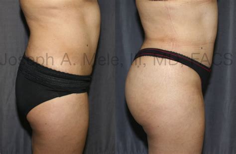 However, tummy tuck belt before and after photos doesn't necessarily mean the product will deliver results. Brazilian Butt Lifts (BBL) and Fat Grafting