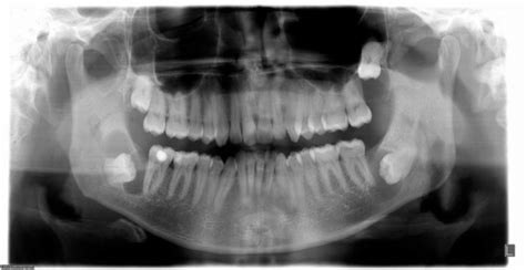 Panoramic Radiograph Showing Cystic Area Around The Unerupted Teeth In