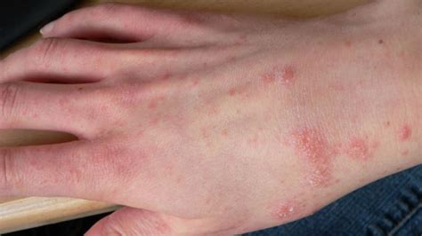 Herbal Treatments For Scabies On Hands Learnskin