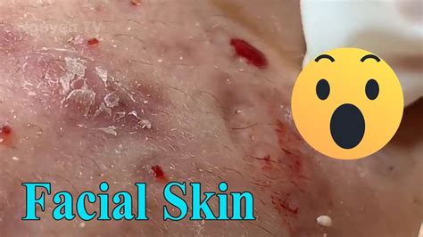 the most satisfying giant blackheads removal best pimple popping videos 07 youtube