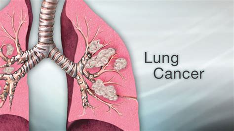 Lung Cancer Cancer Can Affect Just About Any Part Of The Body From The