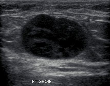 The pulse site in the groin area is the femoral artery. Enlarged Groin Lymph Node | Ultrasound, Sonography, Lymph nodes