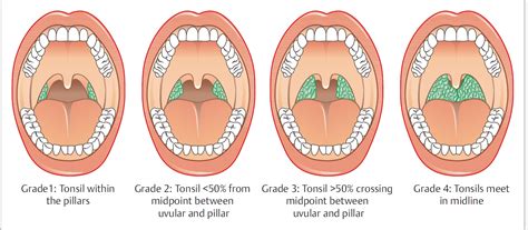 Difference Between Tonsils And Adenoids