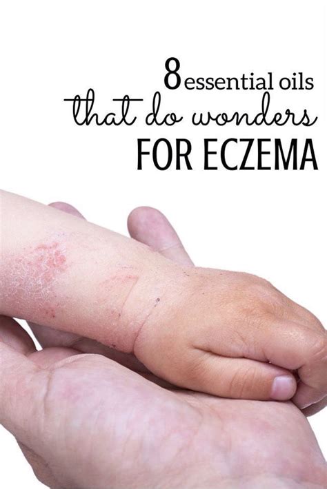 8 Essential Oils For Eczema En 2020 Aceites Esenciales Eczema