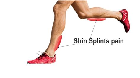 How To Get Rid Of Shin Splints Fast Youtube