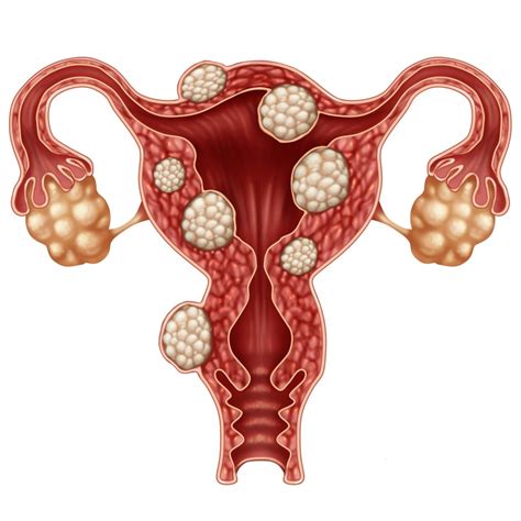 Uterine fibroid usually is benign and asymptomatic in the early stages. RAMAI WANITA TAK TAHU ADA FIBROID. INI MENAKUTKAN ...