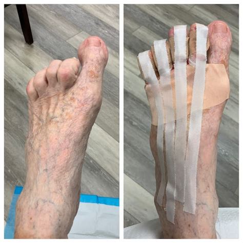 Incisionless Toe Straightening In Fort Myers And Cape Coral Fl Peter B