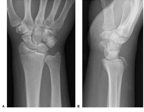 Figure 6 From Radial Styloid Fractures Semantic Scholar