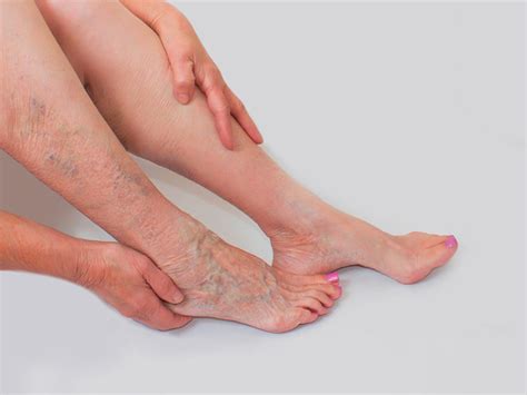 How To Prevent Varicose Veins Before They Start