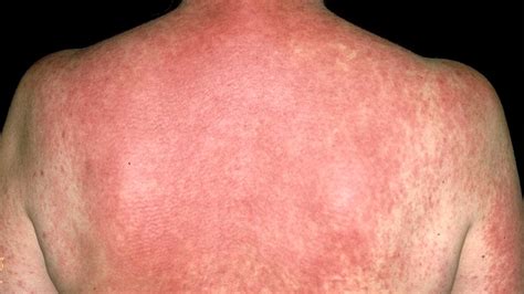 Can Skin Rash Cause Swollen Lymph Nodes