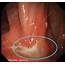 Stomach Ulcer Endoscope View  Stock Image C051/0157 Science Photo