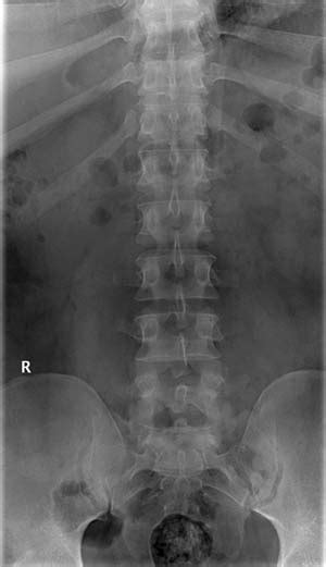 Radiology department of the rijnland hospital in leiderdorp fractures can cause stenosis of the spinal canal especially when there is displacement of bony structures like in burst fractures and fractures with. LUMBAR SPINE 3 | buyxraysonline