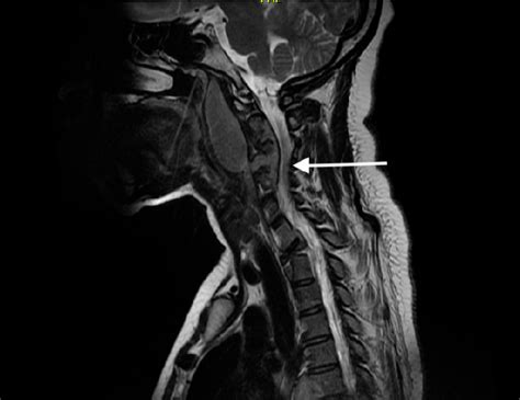 Cervical Mri Showing Retropharyngeal Abscess C1 C5 Extending To The