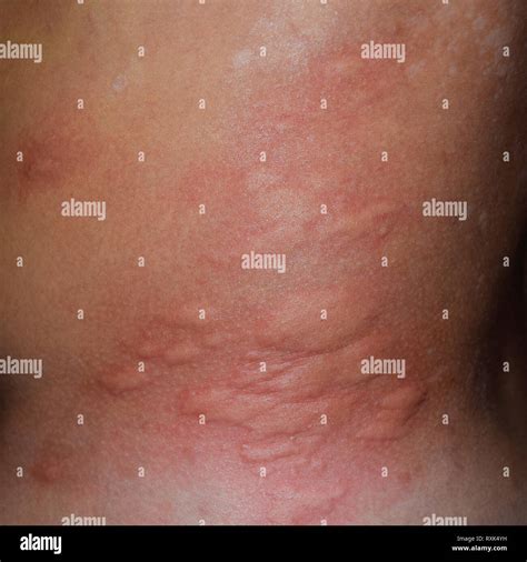 Allergy Skin Back And Sides Allergic Reactions On The Skin In The Form