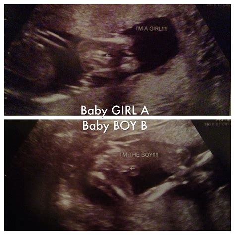 Its A Boy Ultrasound 14 Weeks