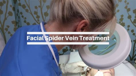 Facial Spider Veins Removal By Short Wave Diathermy The Veincare Centre