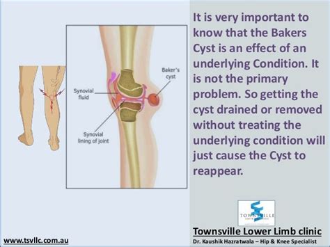 Bakers Cyst Of The Knee