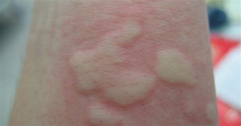 Your Skin For Life Common Rashes Of The Skin Part 4 Urticaria