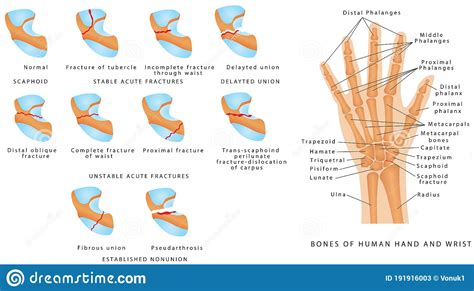 Wrist Fracture Scaphoid Stock Vector Illustration Of Phalanges 191916003