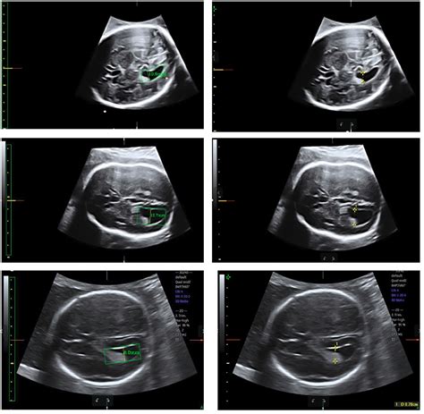 Frontiers Automatic Measurements Of Fetal Lateral Ventricles In 2d