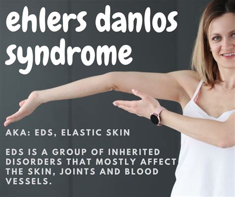 What Is Ehlers Danlos Syndrome How Do I Manage It Rural Health