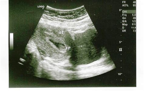 7 Week Transabdominal Ultrasound Babycenter