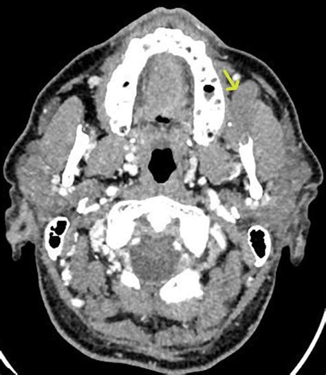 Figure 1 From Ct And Mri Findings Of Head And Neck Massons Tumor A