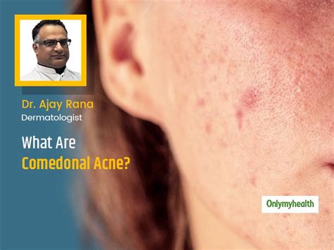 Acne Care 101 What Are Comedonal Acne Their Causes And Tips To Treat