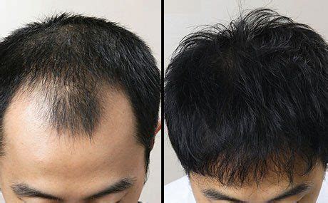 Please personal message for more details. Regrowth Result | Ayurvedic hair oil, Hair regrowth, Hair oil