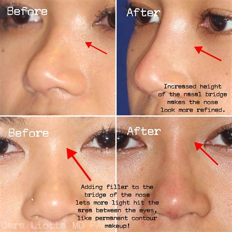 Revision Rhinoplasty Dr Dara Liotta