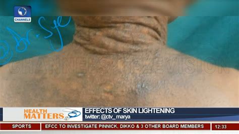 Skin Lightening Dangerous To Our Health Dermatologist Highlights