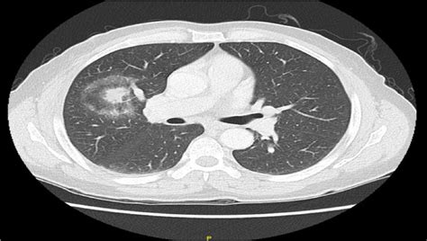 A Chest Ct Scan Showing Right Upper Lobe Mass With Hilar Lymph Node