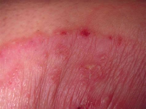 Armpit Rash Causes And Treatments Vlr Eng Br