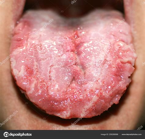 What Causes Fungal Infection In The Mouth Lupon Gov Ph