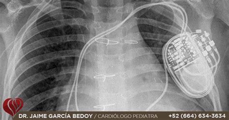 Marcapasos En Niños Dr García Bedoy Cardiólogo Pediatra