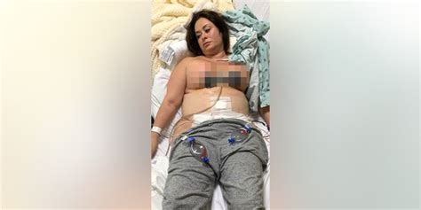 Florida Woman Loses Nipples Nearly Dies After Botched Plastic Surgery Abroad Fox News