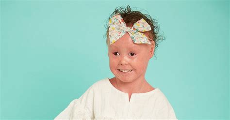 Girl S Rare Condition Means Her Skin Grows Times Faster Than It