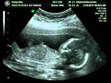 Can you get a dating scan at 7 weeks. Baby scan at 17 weeks pregnant - YouTube