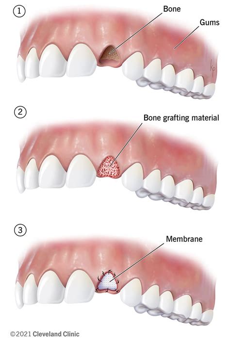 How To Bone Graft Dental Implants Dentist Norcross And Alpharetta Ga
