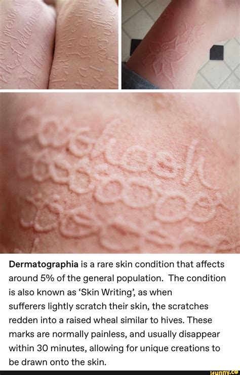 Dermatographia Is A Rare Skin Condition That Affects Around 5 Of The General Population The