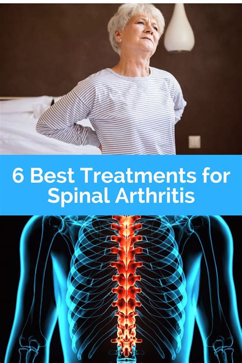 Spinal Arthritis Causes Symptoms And Treatments Spinal Arthritis