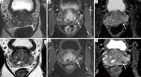 Role Of Prostate Magnetic Resonance Imaging In Active Surveillance Meng Translational