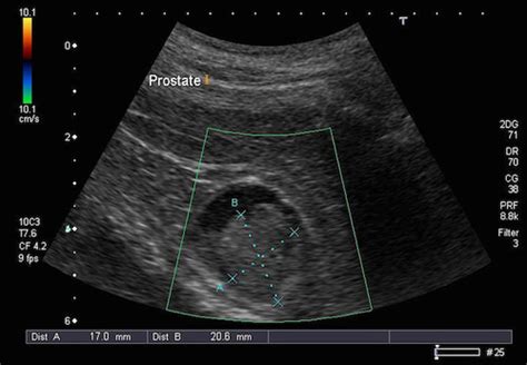 Pelvic Ultrasound K And T Diagnostic Inc